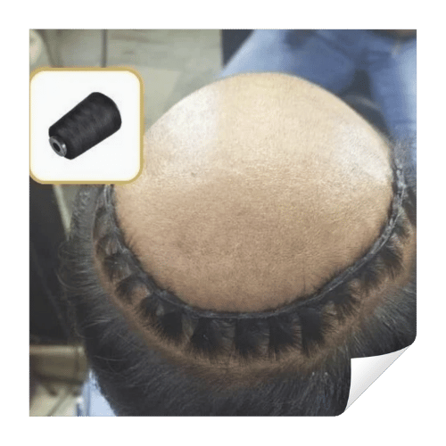 Hair wig weaving or hair patch weaving in salt lake kolkata as a best non-surgical hair replacement for men in kolkata, starting just ₹5999.