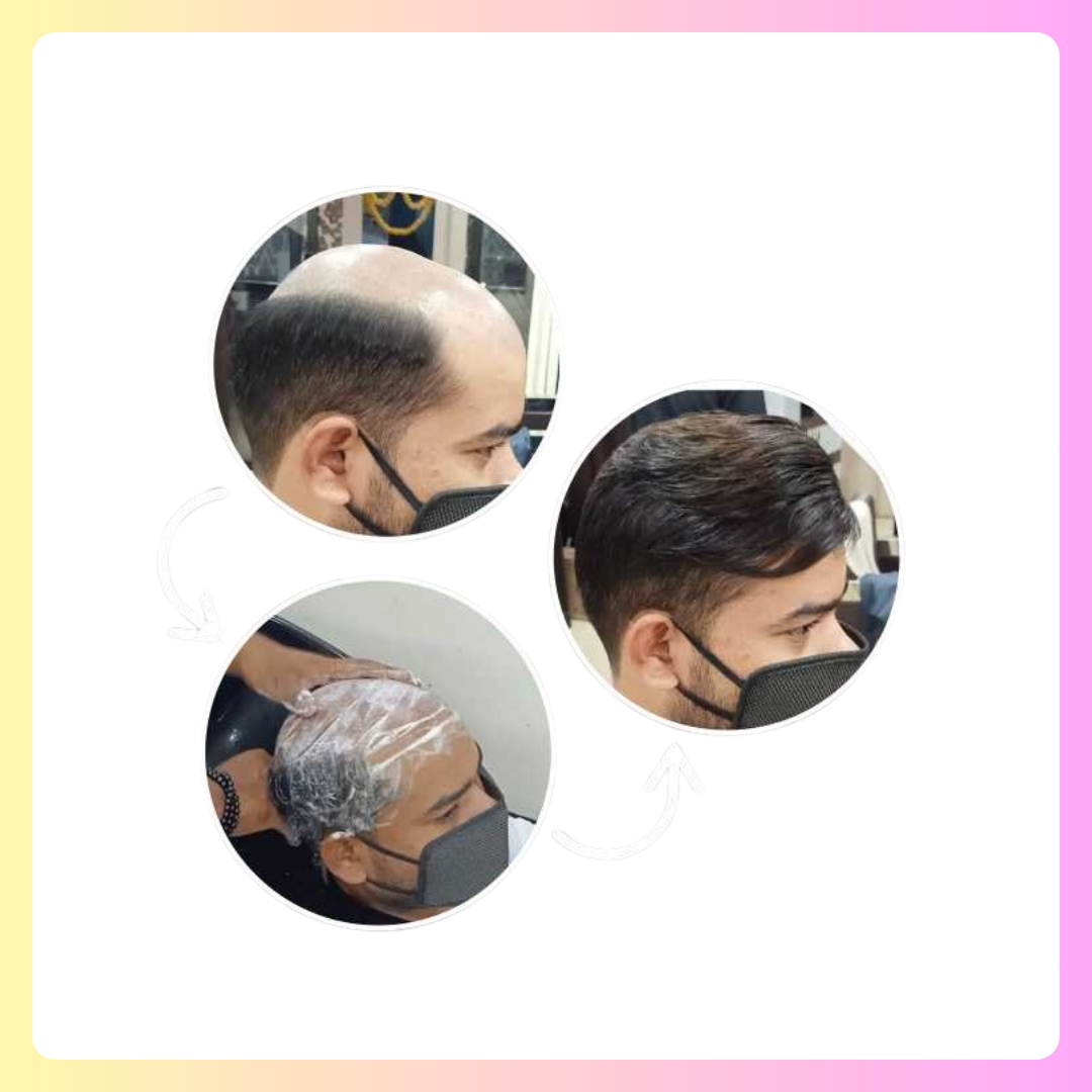 Hair Patch Servicing for Men​​ in Salt Lake Kolkata. Best Hair Patch servicing center in salt lake kolkata. Cost of hair patch servicing for men in salt lake kolkata starting just rs 499.